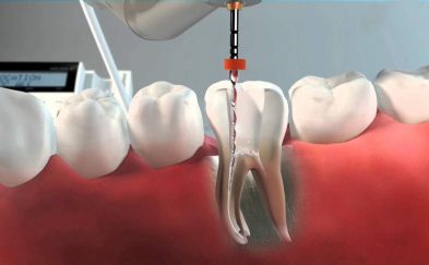 Endodoncia-tratamiento