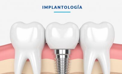 implantes-dentales